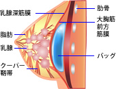 大胸筋膜下法