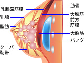 大胸筋下法 