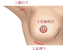 切開部位について