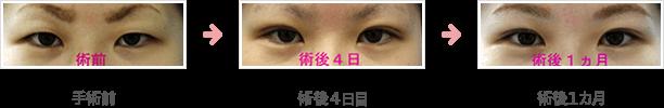 脱脂+埋没法症例